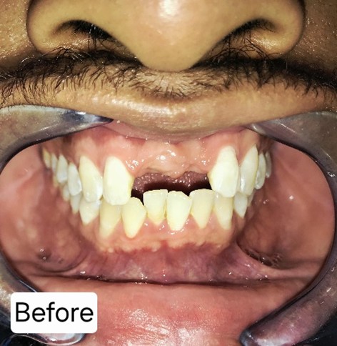 Aesthetic Implants Before