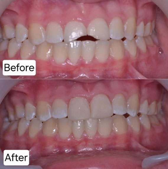 Composite Bonding