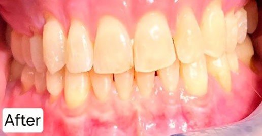 Invisalign Case Study