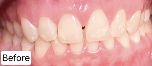 Invisalign Case Study