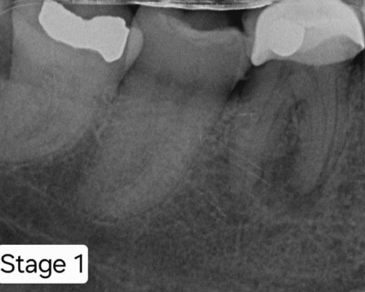 After removing the old crown, the RCT is completed