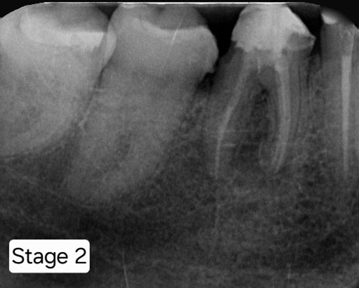 Posts are placed for a new crown.