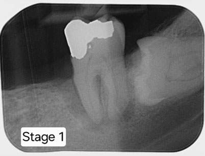 Pathology present in the Lower Left 7 – the patient was motivated to save the tooth.