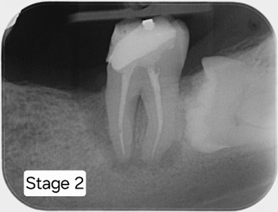 RCT completed with posts placed.