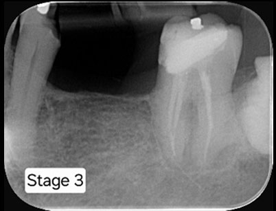 Follow up x-ray taken after 6 months.
